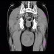 Complication of angiography, bleeding from groin, hematoma in scrotum, hemorrhage: CT - Computed tomography